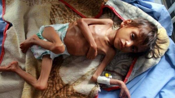 هشدار برنامه جهانی غذا درباره سطح بی سابقه گرسنگی در یمن